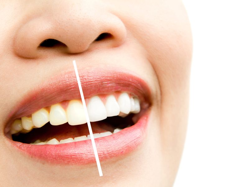 Procedimientos de blanqueamiento dental: Revisión narrativa